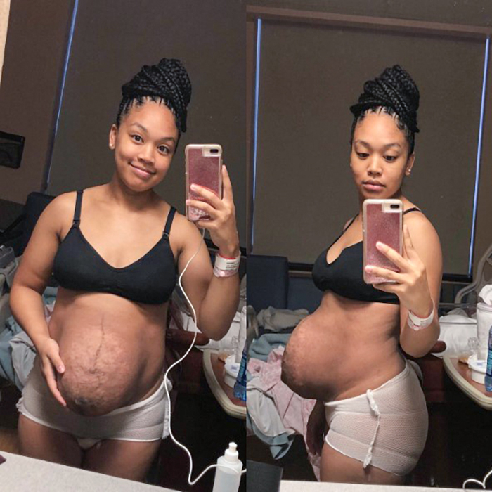 Mom Shares What Her Body Looks Like Hours After Birth & It’s Postpartum Perfection