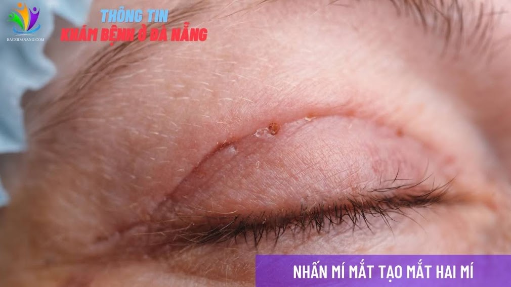 NHẤN MÍ MẮT TẠI ĐÀ NẴNG