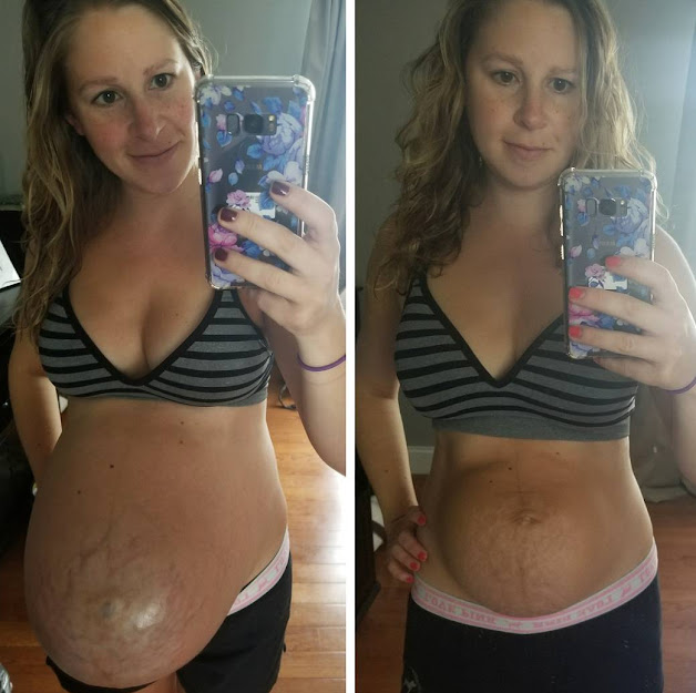 Mother of Two Shares Postpartum Photo to Show ‘Realistic’ Side of Giving Birth