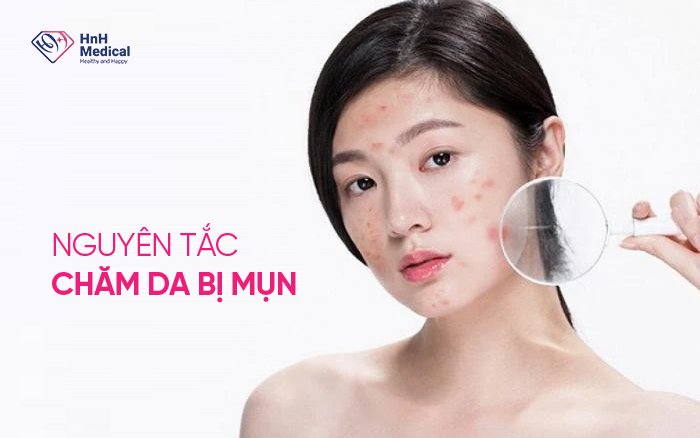 Nguyên tắc khi chăm da bị mụn