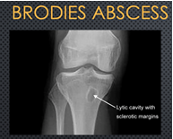 BRODIE'S ABSCESS 