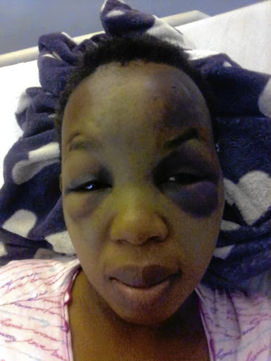 Mavis Sikhosana's face was badly swollen after an alleged beating by nurses in Middelburg.