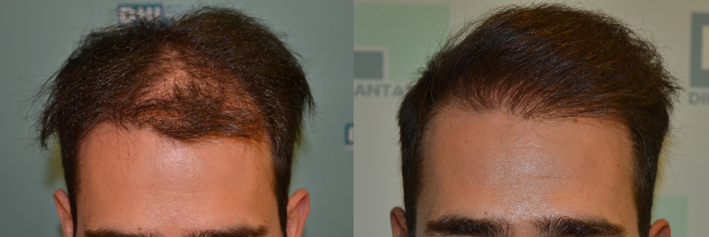 Hair Transplant and How it Works