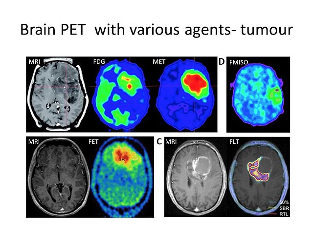 PET CT scan of brain With various agents- tumor 