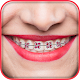 Download Braces Photo For PC Windows and Mac 1