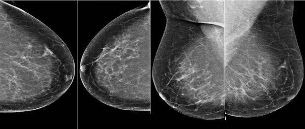 A mammogram showing four images – two of each breast from different angles.