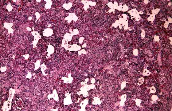 Histopathology of chronic granulomatous interstitial pneumonia caused by R. equi.