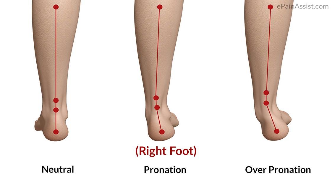 Overpronation of Foot|Mechanism of Injury|Diagnosis|Treatment-Gait ...