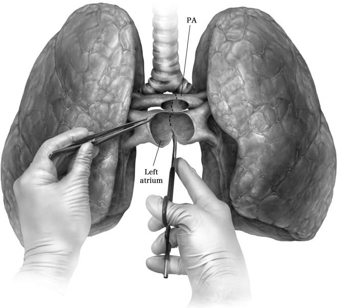 Bilateral Lung Transplantation - Operative Techniques in Thoracic and Cardiovascular Surgery