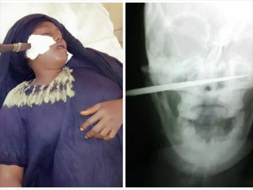 X-ray image showing the knife lodged in Fatuma Ibrahim's cheek