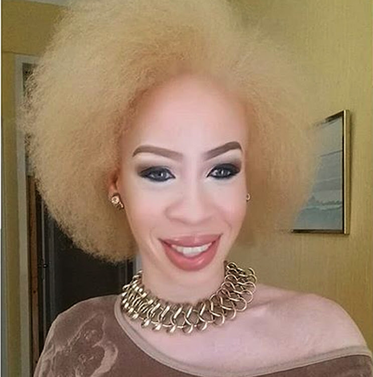 Refilwe Modiselle labels Dove ad featuring woman with albinism as ...