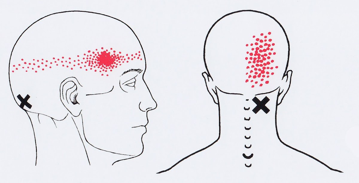 Болезненные точки на голове. Подзатылочные мышцы триггерные точки. Триггерные точки головы и шеи. Мышцы шеи триггерные точки схема. Триггерные точки мышц шеи и головы.