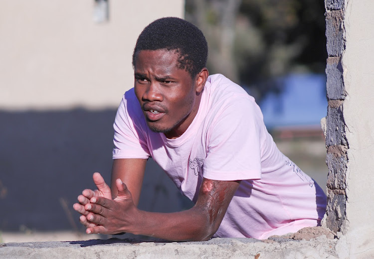 Ofentse Phukubye's left arm was burnt with boiling water when he was a child.