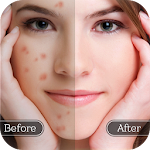 Cover Image of Herunterladen Face Blemish Remover - Glatte Haut und verschönertes Gesicht 1.2 APK