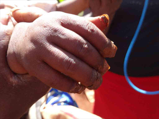 The jigger-infested hand of a three-year-old girl from Mahuria village in Kandara, Murang'a county, November 1, 2017. /JOHN KAMAU