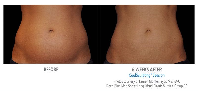 Coolsculpting