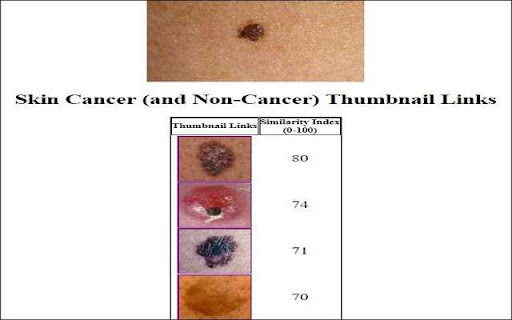 Skin Cancer Image Search