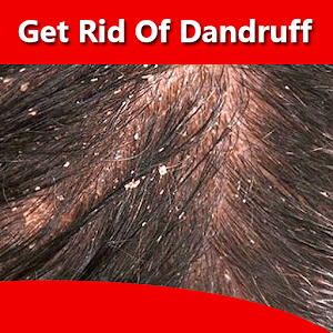 Download How to Get Rid of Dandruff (Natural Methods) For PC Windows and Mac