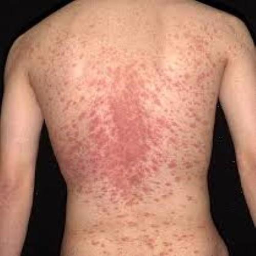 psoriasis treatment Screen 2