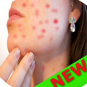 Download Pimples Acne Treatment and Remedies at Home : FREE For PC Windows and Mac