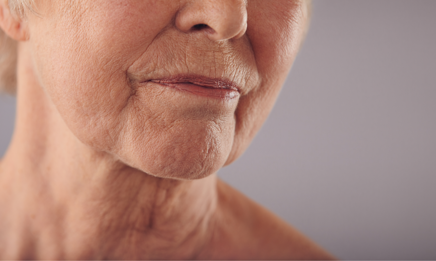 Fillers met hyaluronzuur voor verbetering van de marionettelijnen en neuslippenplooi. 