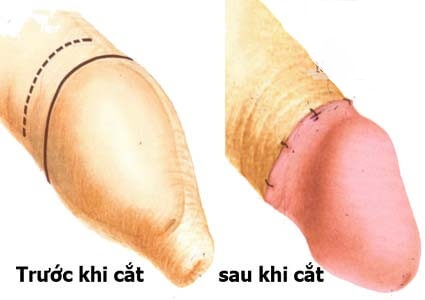 Hình ảnh sau khi cắt bao quy đầu