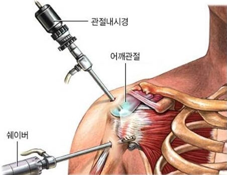 어깨 관절 내시경 수술 모습