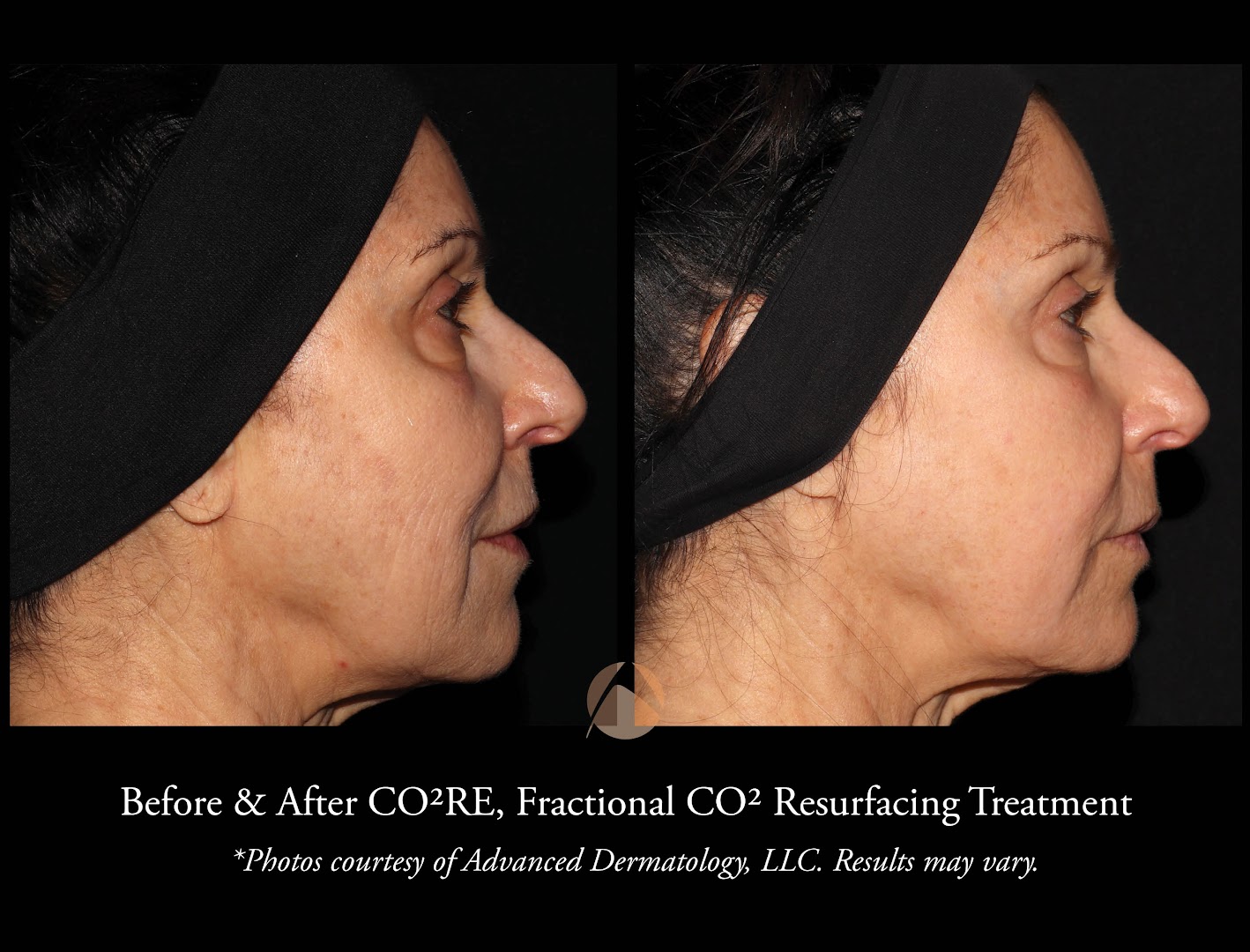 London Medical Spa - CO2 LASER RESURFACING 2/15/22. - Dr. Hal London Here  is another aggressive CO2 laser treatment of the face. This lovely patient  of mine asked me what would make