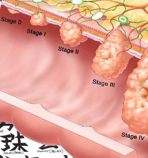 http://healthfavo.com/wp-content/uploads/2014/02/colon-cancer-stages.jpg