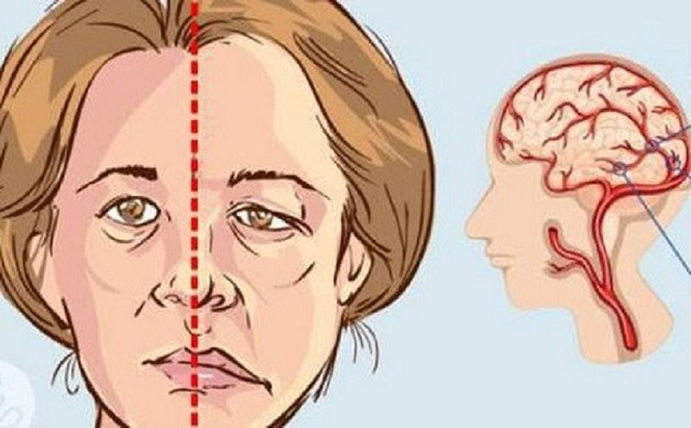 dấu hiệu tai biến mạch máu não