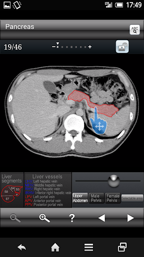 Abdominal CT Sectional Walker