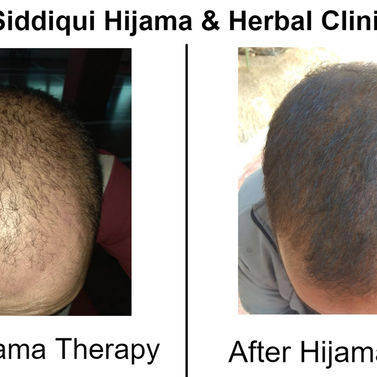 Siddiqui Hijama Cupping Herbal Clinic Top Rated Hijama Delhi