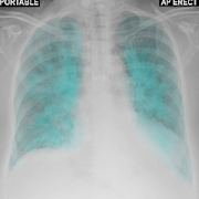 Chest X-Ray And Pathology  Icon