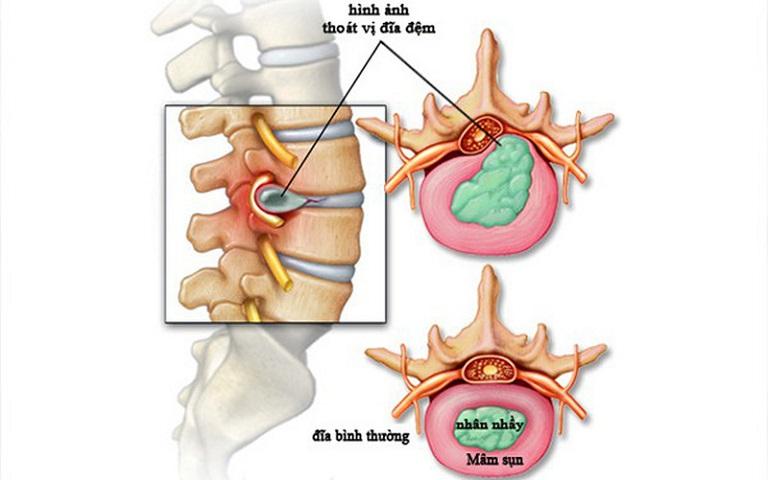 Thoát vị đĩa đệm là gì?