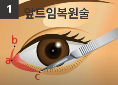 앞트임복원-최종1.png