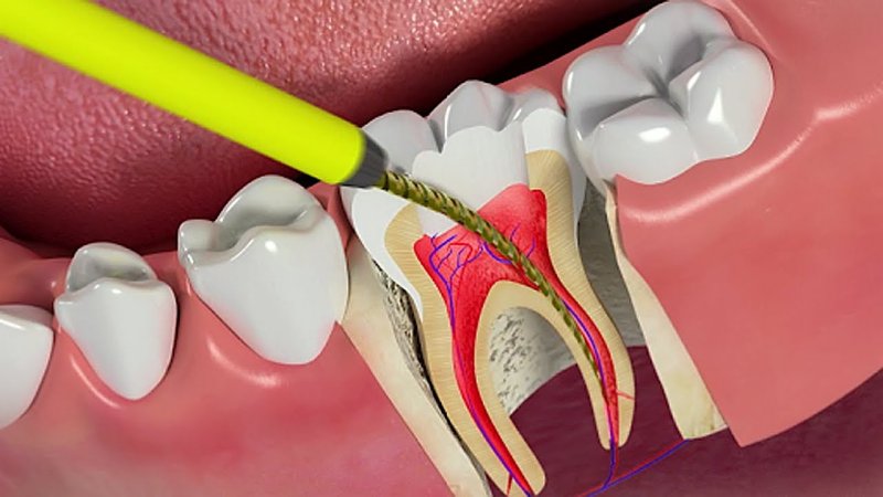 Sâu răng nặng khiến tủy răng bị viêm nhiễm nghiêm trọng