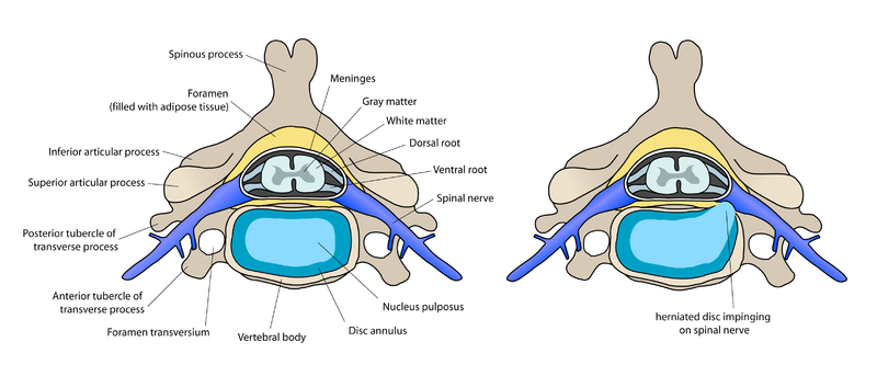 Fichier: ACDF coronal english.png