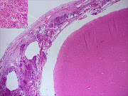 Histopathology of bacterial Meningitis.