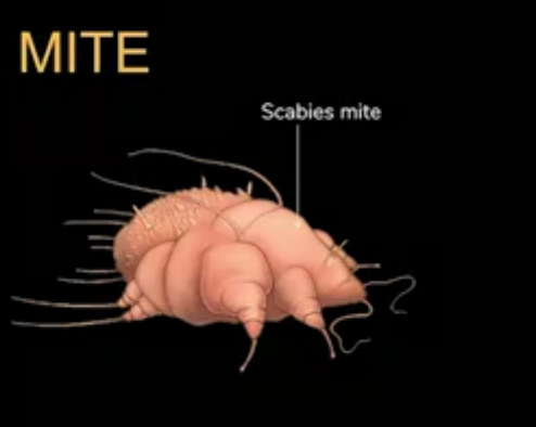 scabies mite