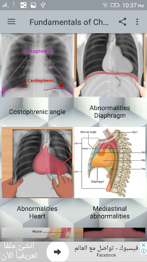 Chest X-Ray Interpretation