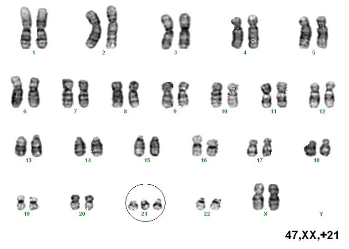 Nhiễm sắc thể trong hội chứng Down