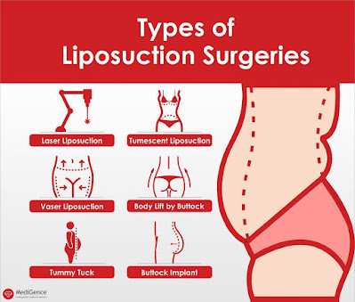 Liposuction Treatment Cost in India | Best Hospitals for Liposuction  Treatment in India | MediGence