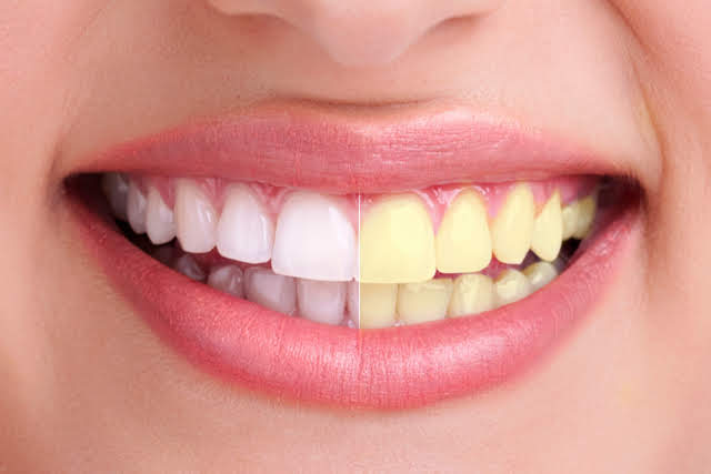 6 sustancias que manchan los dientes (Odontología)