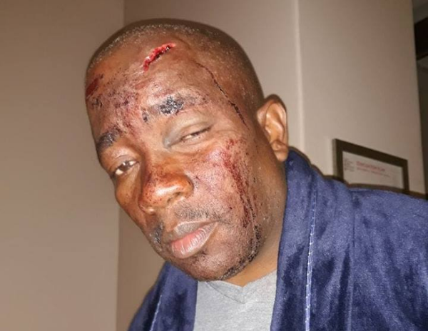 Hartley Sandy Ngoato posted a picture of his injuries after what he calls a racist attack at Hartbeespoort Dam.