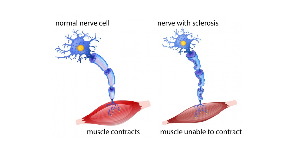 A comparison image showing two nerve cells, one healthy and one affected by degeneration. The healthy nerve cell is depicted as a vibrant, well-structured cell with a clear myelin sheath. The sclerosis-affected nerve, however, shows damaged and deteriorating myelin, illustrating the characteristic damage caused by multiple sclerosis.