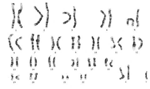 https://upload.wikimedia.org/wikipedia/commons/f/fb/Klinefelter%27s_Syndrome_XXY_DNA.jpg
