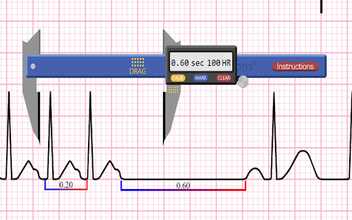 Apex EKG Caliper