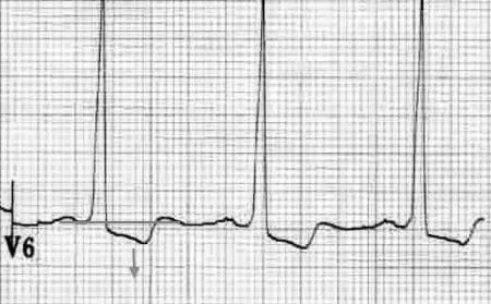 Padrão de Strain no eletrocardiograma - saiba mais 