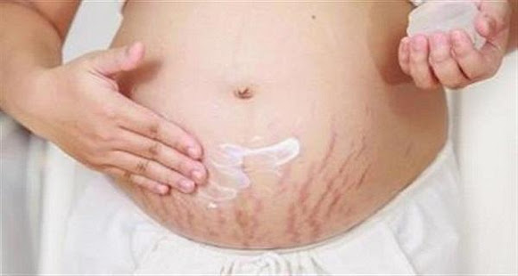 Natural Stretch Marks Removal(圖4)-速報App