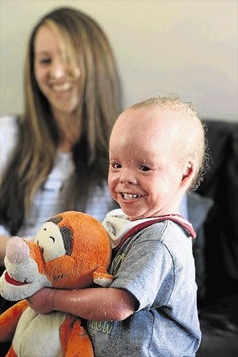 JUST A BOY: Mason Van Dyk was born with 'Harlequin ichthyosis', a rare disorder that occurs in about one in a million babies. He is the only surviving patient in South Africa